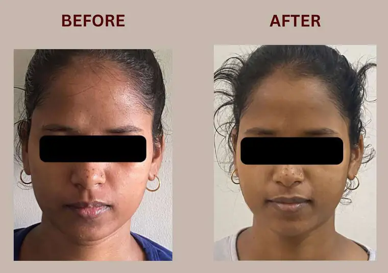 Anima: Bhealix इस्तेमाल से पहले और बाद में
