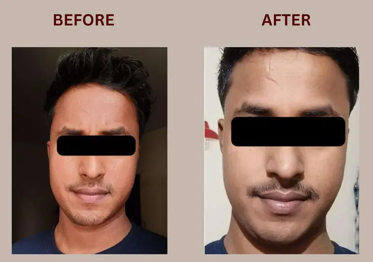 Chotu: Bhealix इस्तेमाल से पहले और बाद में