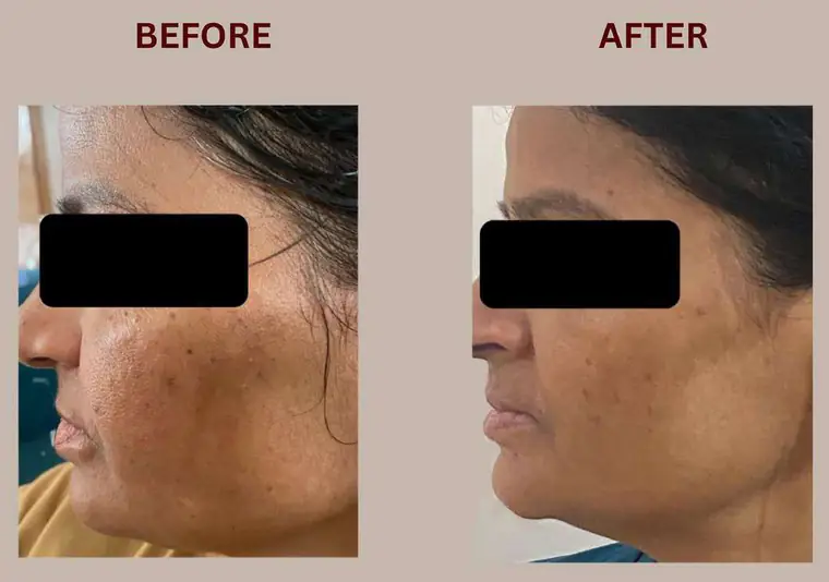 Darshana: Bhealix इस्तेमाल से पहले और बाद में