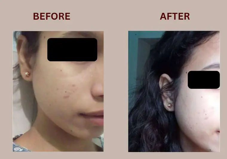 Sakshi: Bhealix इस्तेमाल से पहले और बाद में