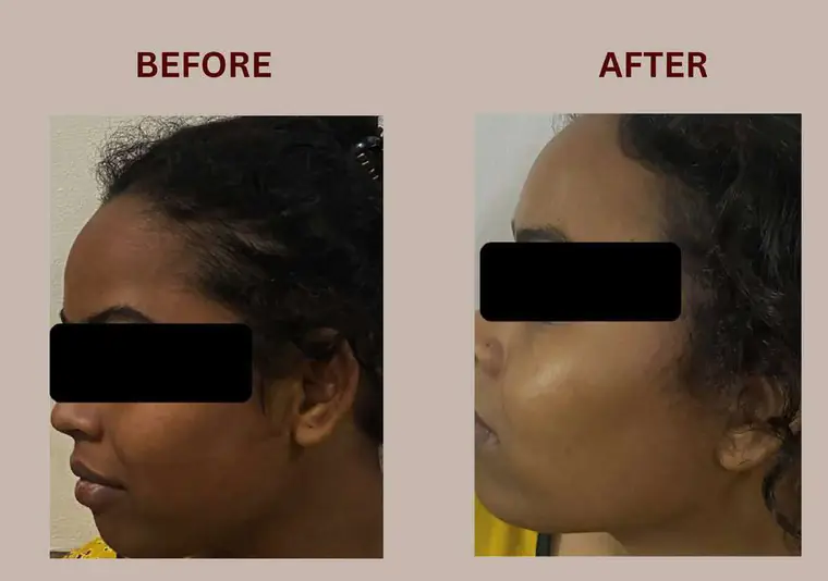Shivani: Bhealix इस्तेमाल से पहले और बाद में